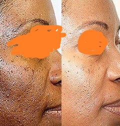 chemical peel for acne.png