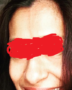 skinlite cream result.png