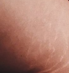 tca peel for stretch marks.png