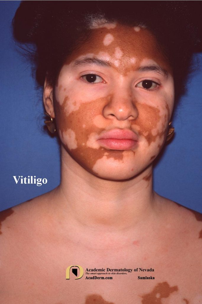 Vitiligo1Samlaska-683x1024-1.jpg