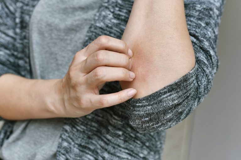 Psoriasis scratch skin allergy diseases problem close up of atopic dermatitis rash